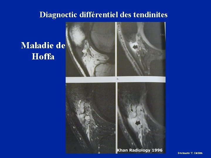Diagnoctic différentiel des tendinites Maladie de Hoffa Documents Y. Carillon 