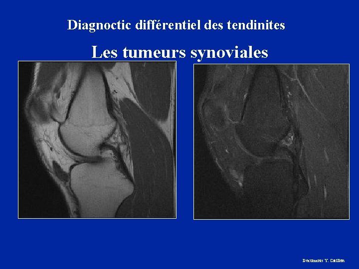 Diagnoctic différentiel des tendinites Les tumeurs synoviales Documents Y. Carillon 