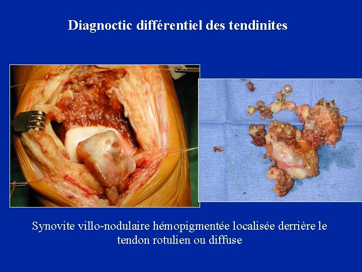 Diagnoctic différentiel des tendinites Synovite villo-nodulaire hémopigmentée localisée derrière le tendon rotulien ou diffuse