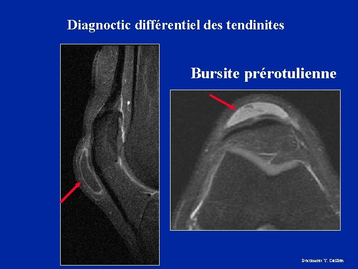 Diagnoctic différentiel des tendinites Bursite prérotulienne Documents Y. Carillon 