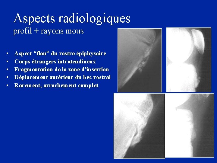 Aspects radiologiques profil + rayons mous • • • Aspect “flou” du rostre épiphysaire