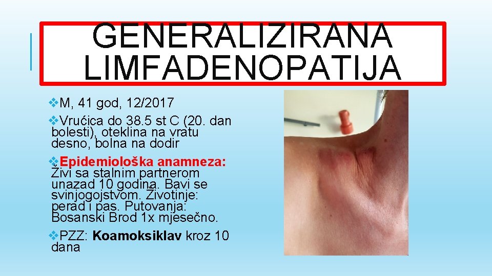 GENERALIZIRANA LIMFADENOPATIJA v. M, 41 god, 12/2017 v. Vrućica do 38. 5 st C