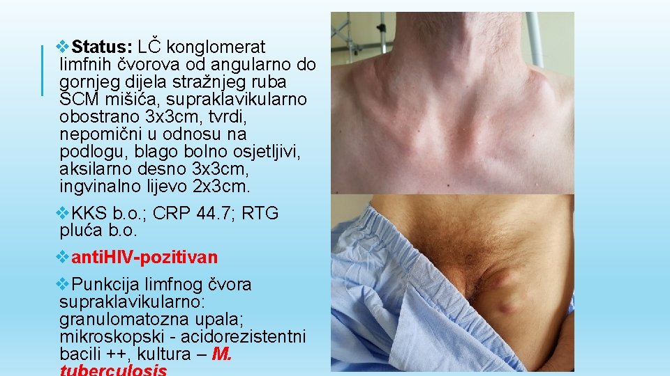 v. Status: LČ konglomerat limfnih čvorova od angularno do gornjeg dijela stražnjeg ruba SCM