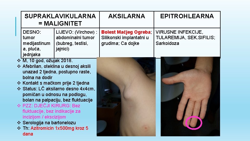 SUPRAKLAVIKULARNA = MALIGNITET v v v v AKSILARNA EPITROHLEARNA DESNO: LIJEVO: (Virchow) : Bolest