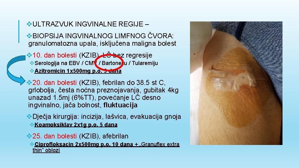 v. ULTRAZVUK INGVINALNE REGIJE – v. BIOPSIJA INGVINALNOG LIMFNOG ČVORA: granulomatozna upala, isključena maligna