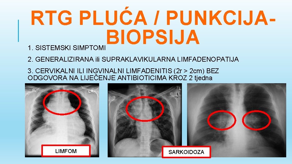 RTG PLUĆA / PUNKCIJABIOPSIJA 1. SISTEMSKI SIMPTOMI 2. GENERALIZIRANA ili SUPRAKLAVIKULARNA LIMFADENOPATIJA 3. CERVIKALNI