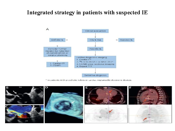 Integrated strategy in patients with suspected IE 