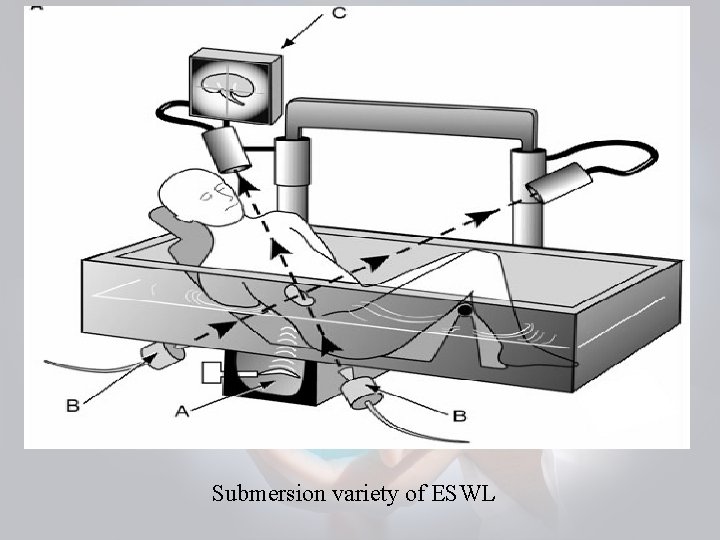 Submersion variety of ESWL 