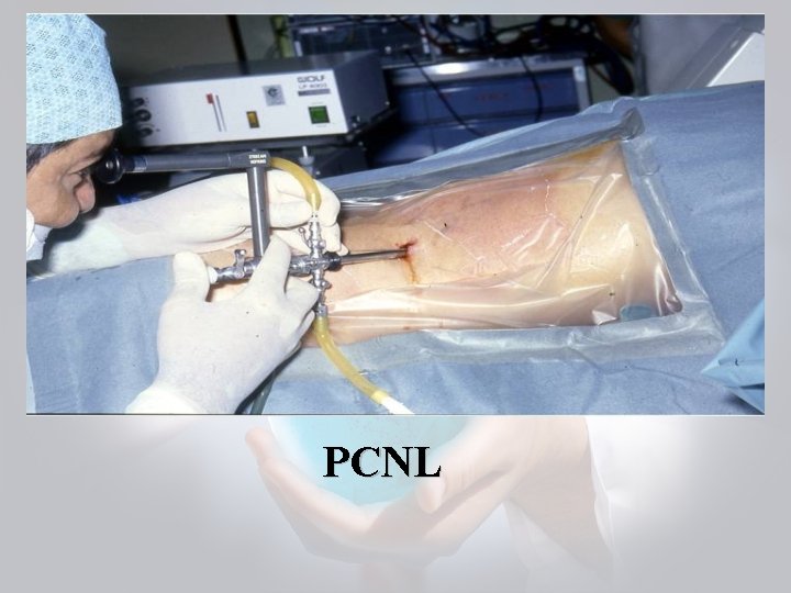 PCNL 