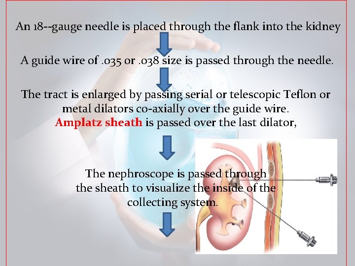 An 18‐‐gauge needle is placed through the flank into the kidney A guide wire