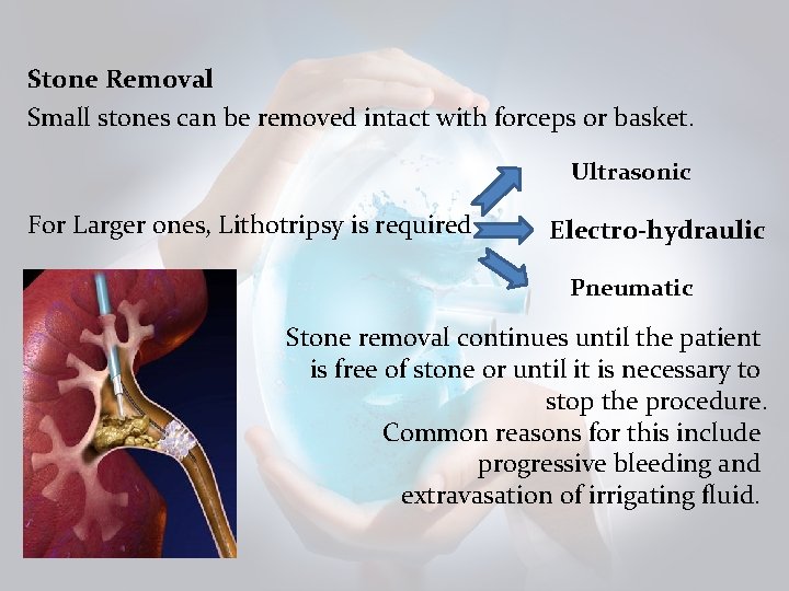  Stone Removal Small stones can be removed intact with forceps or basket. Ultrasonic