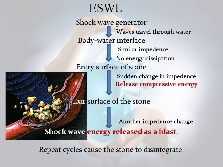 ESWL Shock wave generator Waves travel through water Body‐water interface Similar impedence No energy