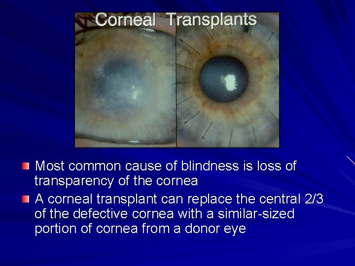 Most common cause of blindness is loss of transparency of the cornea A corneal