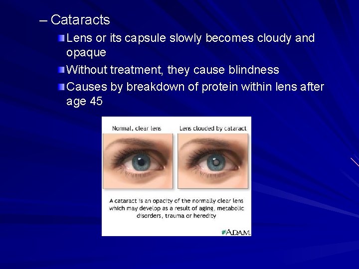 – Cataracts Lens or its capsule slowly becomes cloudy and opaque Without treatment, they
