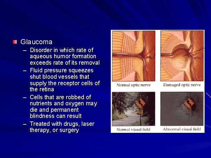 Glaucoma – Disorder in which rate of aqueous humor formation exceeds rate of its