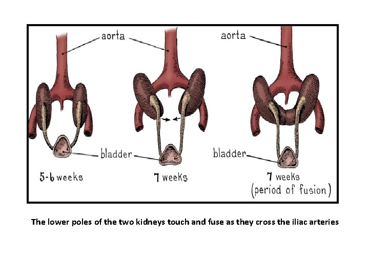 The lower poles of the two kidneys touch and fuse as they cross the The lower poles of the two kidneys touch and fuse as they cross the