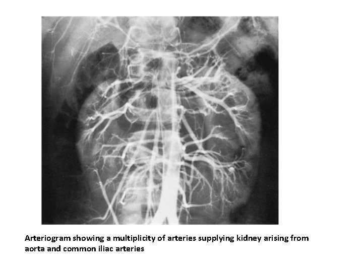 Arteriogram showing a multiplicity of arteries supplying kidney arising from aorta and common iliac Arteriogram showing a multiplicity of arteries supplying kidney arising from aorta and common iliac