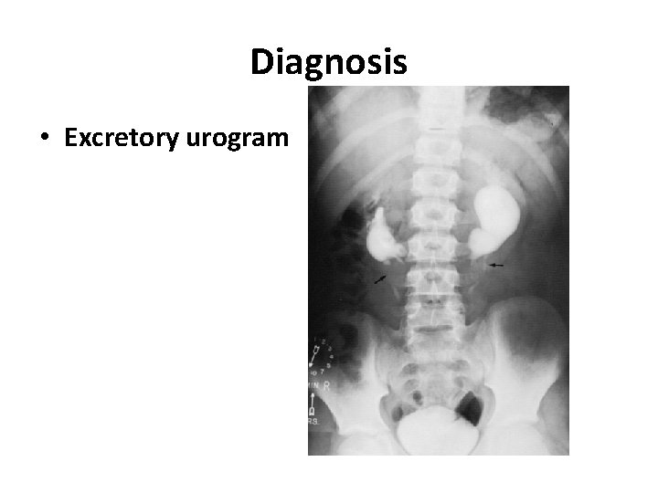 Diagnosis • Excretory urogram Diagnosis • Excretory urogram
