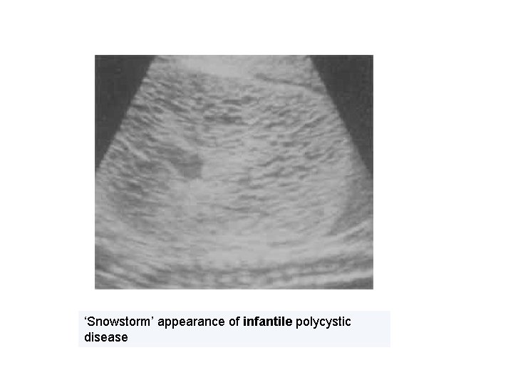 Kidney and Ureters Agenesis Horseshoe kidneys congenital cysts