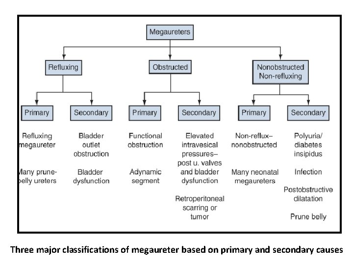 Three major classifications of megaureter based on primary and secondary causes Three major classifications of megaureter based on primary and secondary causes