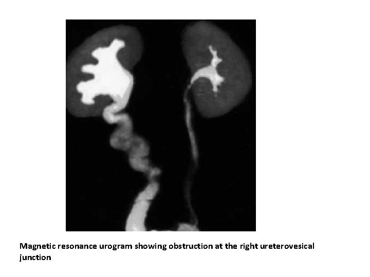 Magnetic resonance urogram showing obstruction at the right ureterovesical junction Magnetic resonance urogram showing obstruction at the right ureterovesical junction