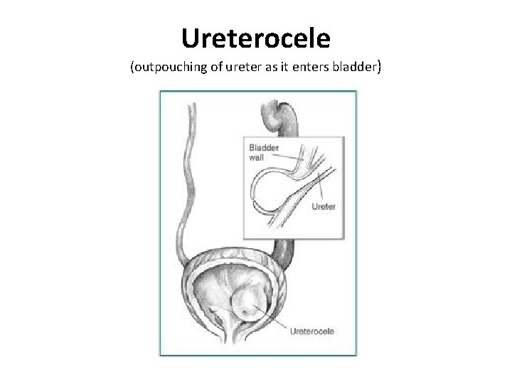 Ureterocele (outpouching of ureter as it enters bladder) Ureterocele (outpouching of ureter as it enters bladder)