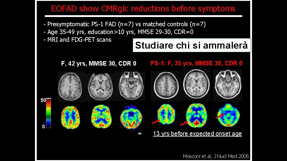 EOFAD show CMRglc reductions before symptoms - Presymptomatic PS-1 FAD (n=7) vs matched controls