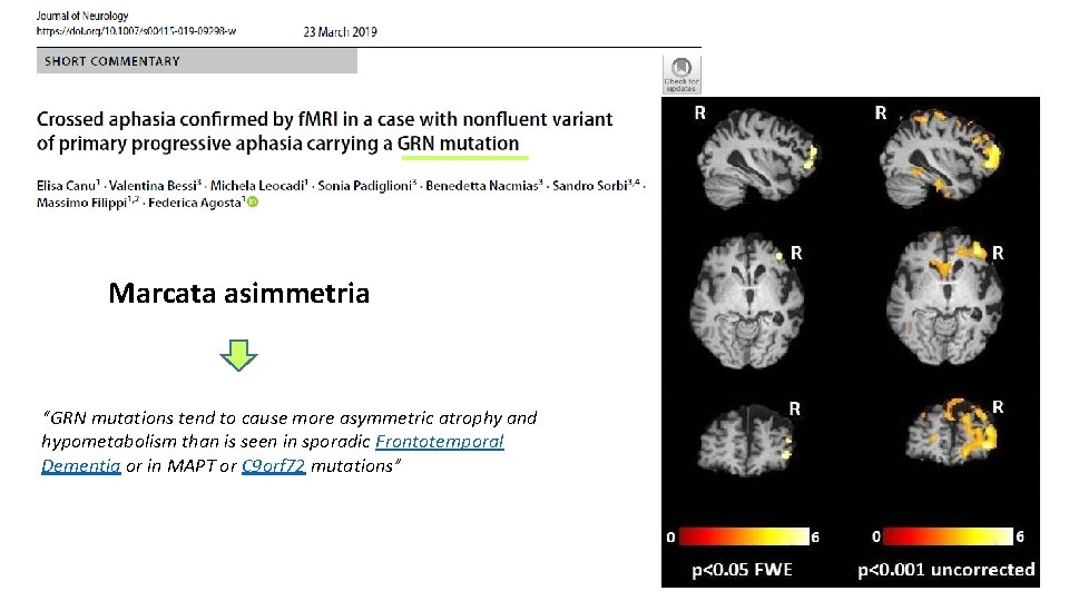 Marcata asimmetria “GRN mutations tend to cause more asymmetric atrophy and hypometabolism than is