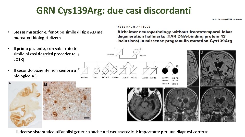 GRN Cys 139 Arg: due casi discordanti • Stessa mutazione, fenotipo simile di tipo