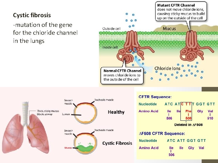 Cystic fibrosis -mutation of the gene for the chloride channel in the lungs 
