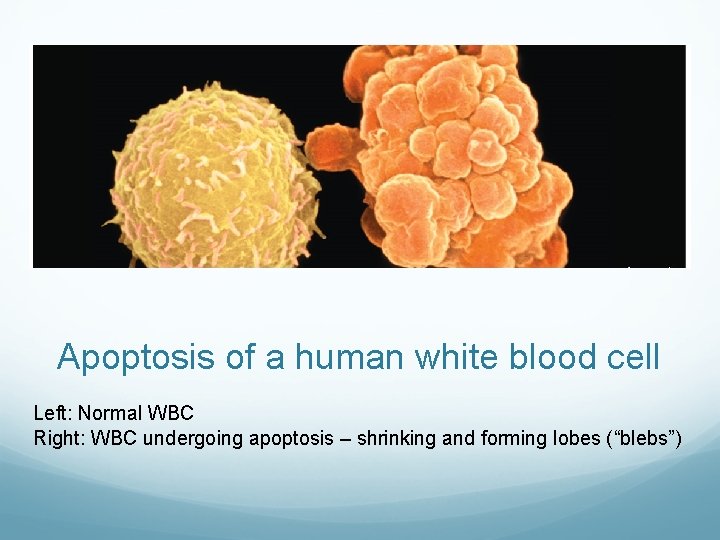 Apoptosis of a human white blood cell Left: Normal WBC Right: WBC undergoing apoptosis