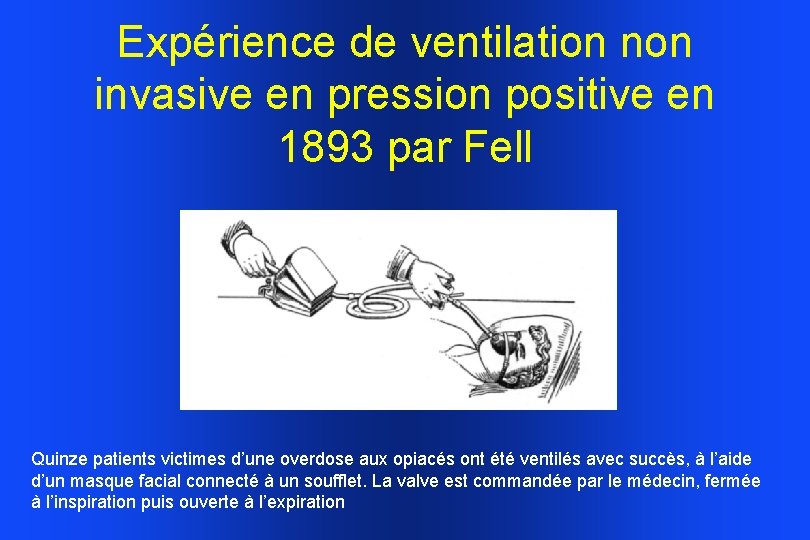 Expérience de ventilation non invasive en pression positive en 1893 par Fell Quinze patients Expérience de ventilation non invasive en pression positive en 1893 par Fell Quinze patients