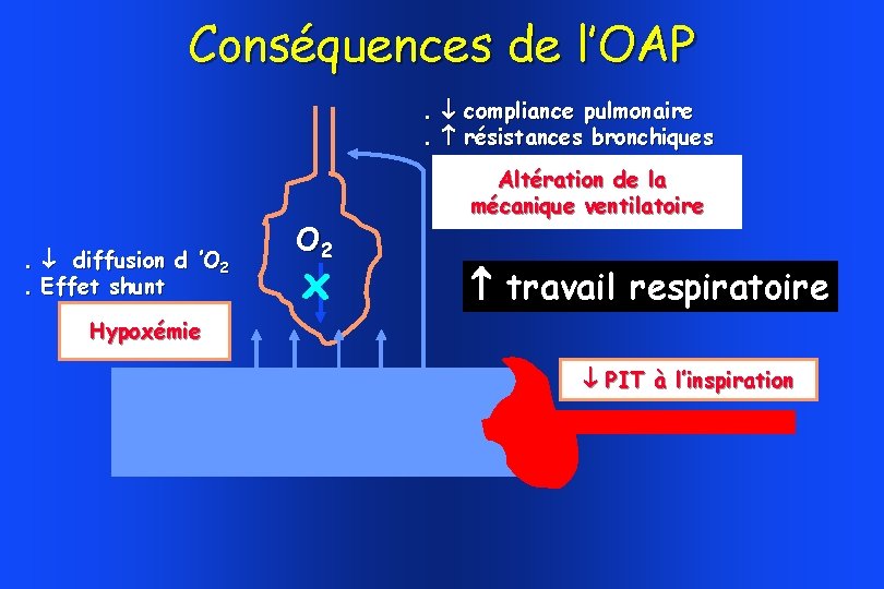 Conséquences de l’OAP. compliance pulmonaire. résistances bronchiques . diffusion d ’O 2. Effet shunt Conséquences de l’OAP. compliance pulmonaire. résistances bronchiques . diffusion d ’O 2. Effet shunt
