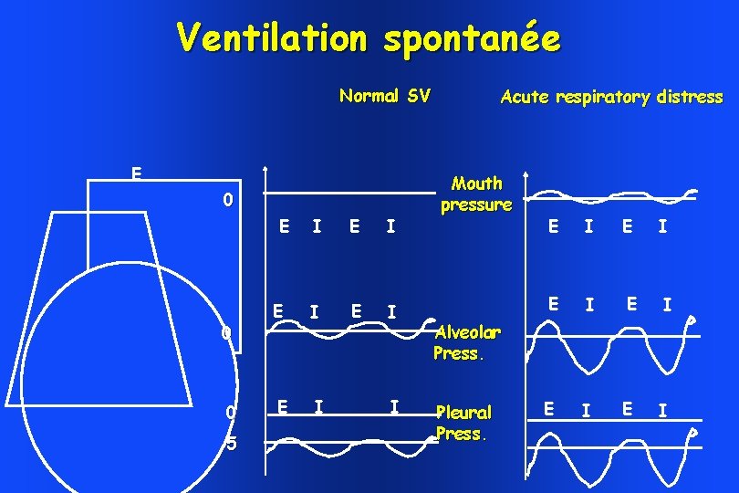 Ventilation spontanée Normal SV E 0 I E I E I E 0 0 Ventilation spontanée Normal SV E 0 I E I E I E 0 0