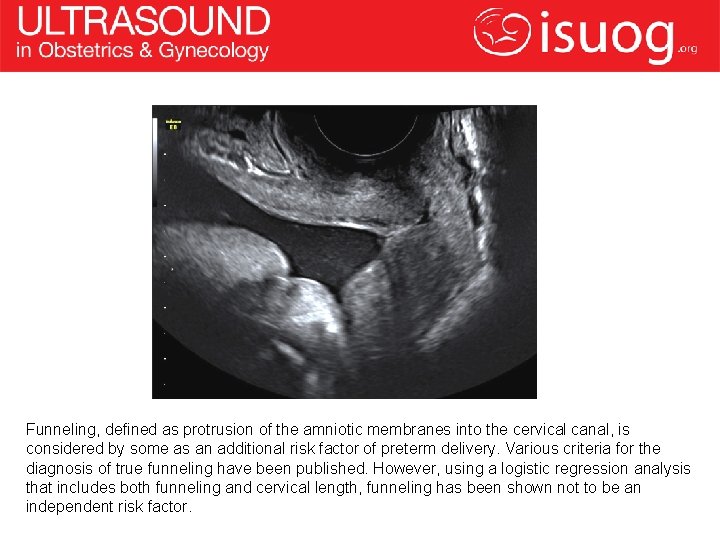 Funneling, defined as protrusion of the amniotic membranes into the cervical canal, is considered