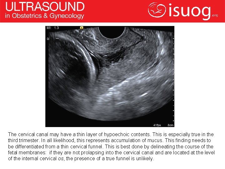 The cervical canal may have a thin layer of hypoechoic contents. This is especially