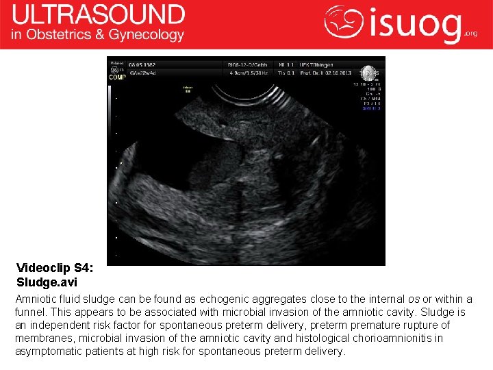 Videoclip S 4: Sludge. avi Amniotic fluid sludge can be found as echogenic aggregates