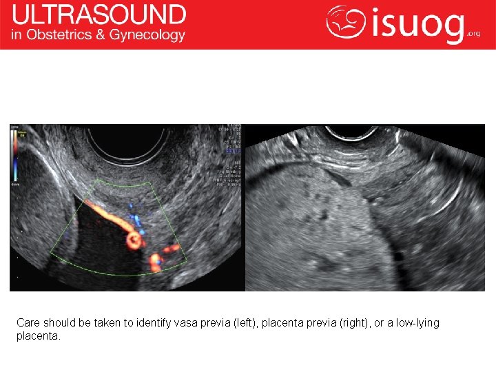 Care should be taken to identify vasa previa (left), placenta previa (right), or a
