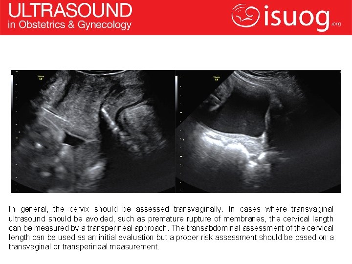 In general, the cervix should be assessed transvaginally. In cases where transvaginal ultrasound should