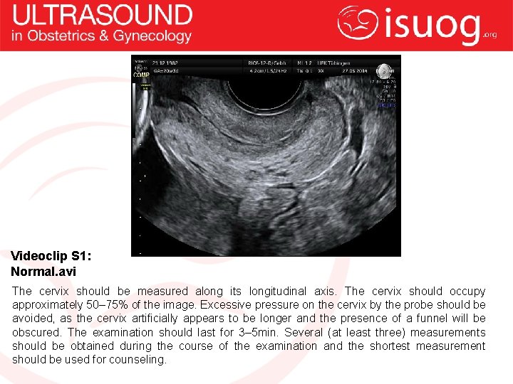 Videoclip S 1: Normal. avi The cervix should be measured along its longitudinal axis.