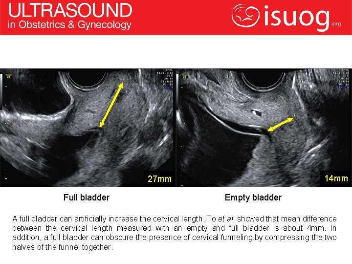 14 mm 27 mm Full bladder Empty bladder A full bladder can artificially increase