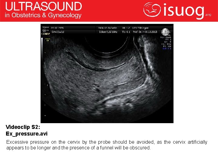 Videoclip S 2: Ex_pressure. avi Excessive pressure on the cervix by the probe should