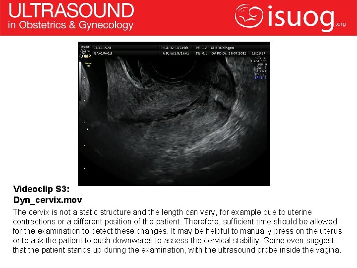 Videoclip S 3: Dyn_cervix. mov The cervix is not a static structure and the