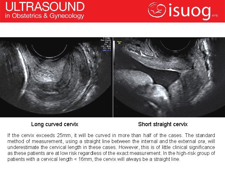 Long curved cervix Short straight cervix If the cervix exceeds 25 mm, it will