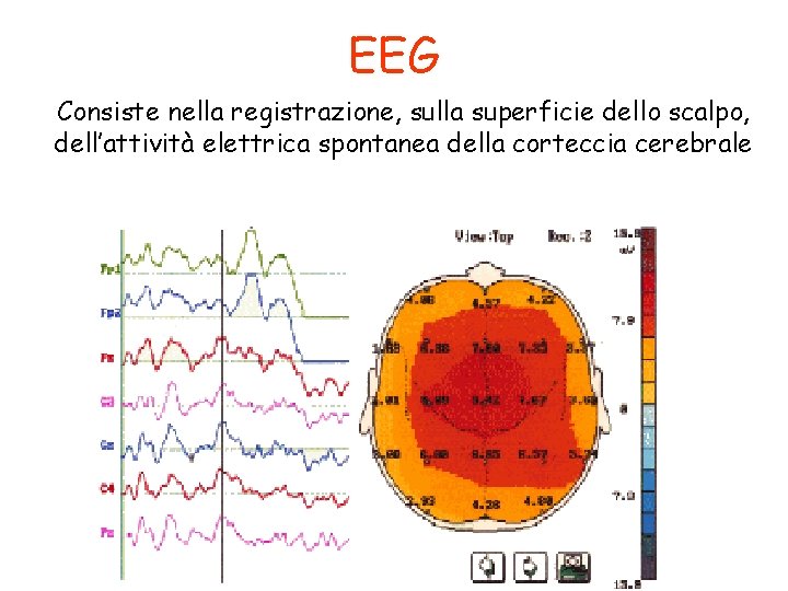 EEG Consiste nella registrazione, sulla superficie dello scalpo, dell’attività elettrica spontanea della corteccia cerebrale