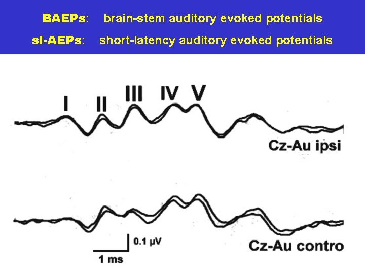 BAEPs: sl-AEPs: brain-stem auditory evoked potentials short-latency auditory evoked potentials 