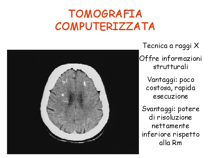 TOMOGRAFIA COMPUTERIZZATA Tecnica a raggi X Offre informazioni strutturali Vantaggi: poco costosa, rapida esecuzione