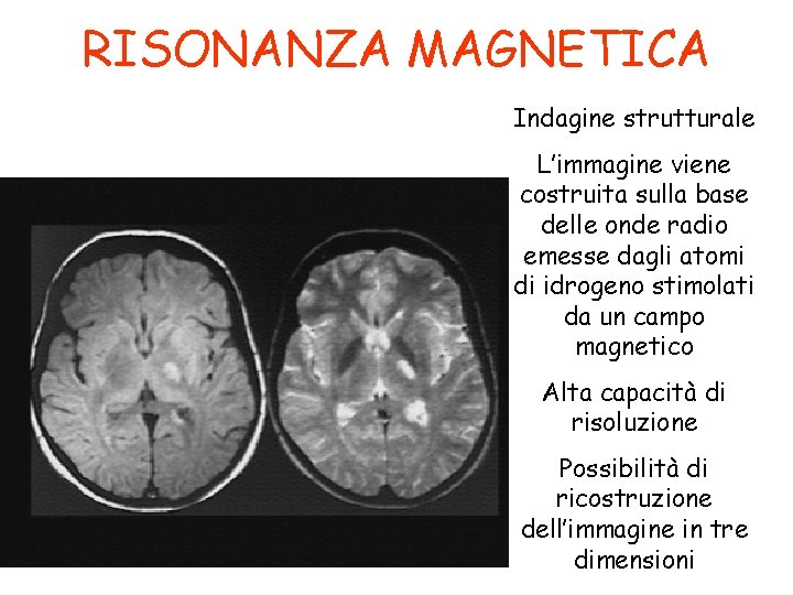 RISONANZA MAGNETICA Indagine strutturale L’immagine viene costruita sulla base delle onde radio emesse dagli