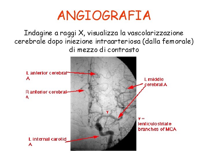 ANGIOGRAFIA Indagine a raggi X, visualizza la vascolarizzazione cerebrale dopo iniezione intraarteriosa (dalla femorale)