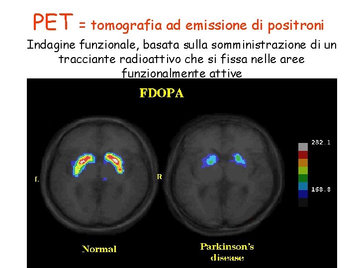 PET = tomografia ad emissione di positroni Indagine funzionale, basata sulla somministrazione di un
